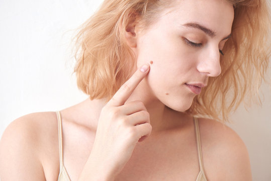 A girl with a mole on her face on white background