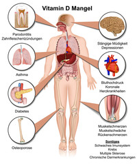 Vitamin D Mangel Anzeichen und Symptome, vektor illustration