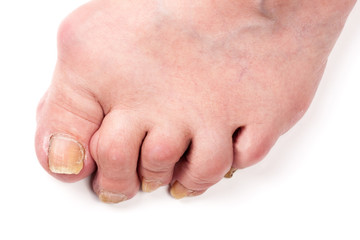 Rheumatoid polyarthritis on foot isolated on white background - obrazy, fototapety, plakaty