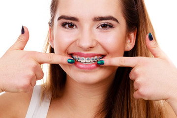 Woman showing her teeth with braces