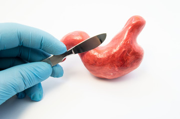 Concept of gastric surgery. Surgeon holding scalpel near anatomical model of stomach. Surgery...