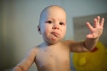 Sad Boy with Chickenpox