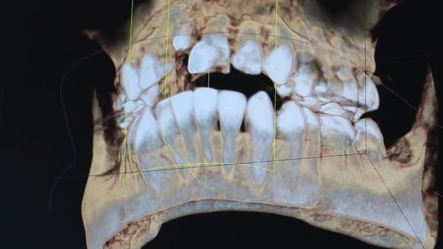 3d x-ray (Roentgen) and jaw check after a sine lift and dental implant