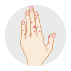 Obraz premium Eczema hand -Front view 手湿疹 正面