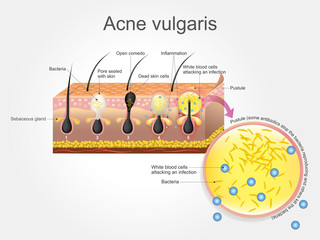 Acne Vulgaris skin. Vector graphic.