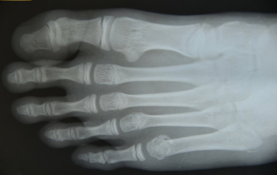 Close up foot  x-ray
