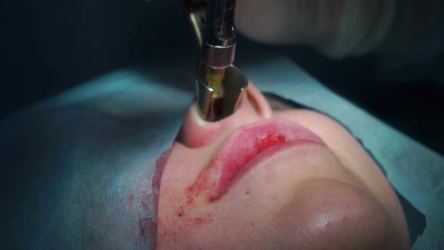 Maxillofacial Surgery, Anesthesia in the nose