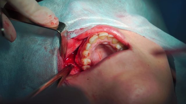 Surgeon sutures the gum, Maxillofacial Surgery