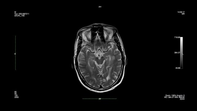 Brain-Magnetic Resonance Imaging-slowly animation
Computed tomography