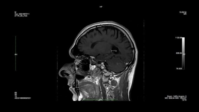 Skull-Magnetic Resonance Imaging
Computed tomography