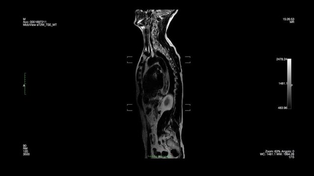 Vertebral column-Magnetic Resonance Imaging
Computed tomography