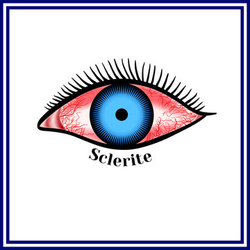 Sclerite. Inflammatory disease of sclera.