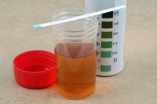 Analyse d'urine avec une bandelette test 