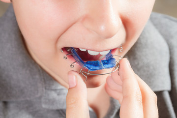Child with orthodontic appliance. Boy holds an orthodontic appliance in his hand