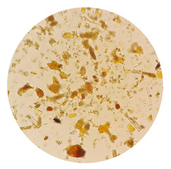 Stool parasites examination test for parasites or eggs in a stool sample with iodine stained under...