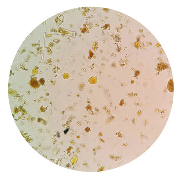 Stool parasites examination test for parasites or eggs in a stool sample with iodine stained under microscope.The parasites are associated with intestinal infections.