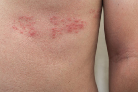 Detail of body skin with Herpes Zoster (Shingles)