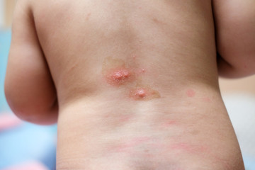 Baby's back with red spot , Blister caused by insect bite