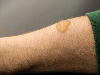 Blister On The Skin Of The Arm