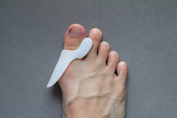 bunion in foot problem