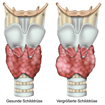 Vergr&ouml;&szlig;erte Schilddr&uuml;se, Kropf vektor illustration