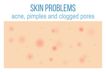 Skin problems such as acne, pimples and clogged pores. Top view of skin. Vector.
