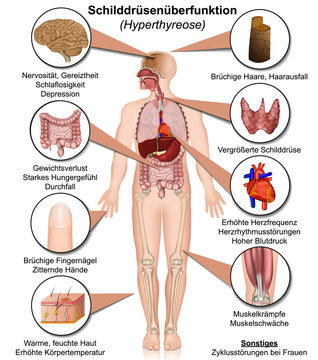 Schilddr&uuml;sen&uuml;berfunktion Hyperthyreose, infografik vektor illustration