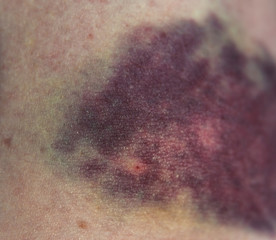 Internal hemorrhage after intravenous injection