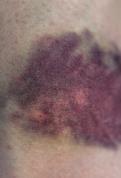 Internal hemorrhage after intravenous injection