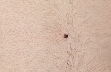 The tick of Ixodidae sits on the belly of a man during a walk in the forest.