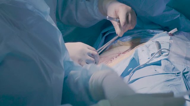 Surgical operation of the abdomen. Suturing