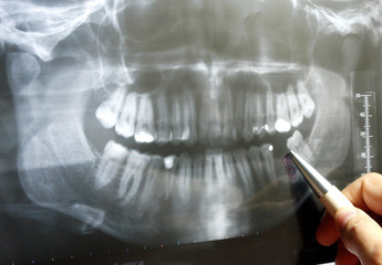 dental X-Ray study