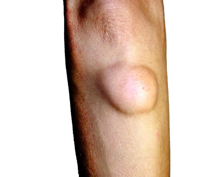 Lipoma on the elbow of the arm