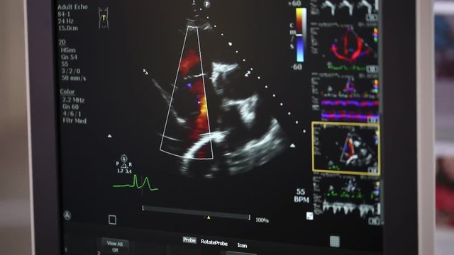 Heart ultrasound