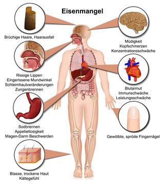 Eisenmangel Symptome des menschlichen Körpers, infografik vektor illustration