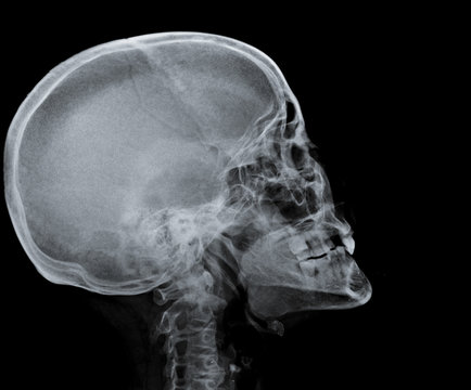 radiography of skull.