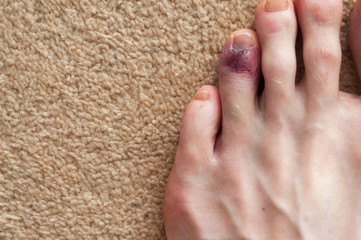 Broken toe showing bruising on skin due to injury