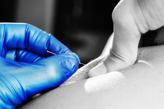 Needle and hands of physiotherapist doing a dry needling in silhouette studio on white background.