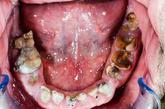 komplett zerst&ouml;rtes gebi&szlig; 