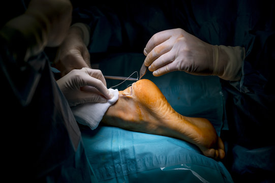 Surgeons doing an achilles tendon surgery in hospital