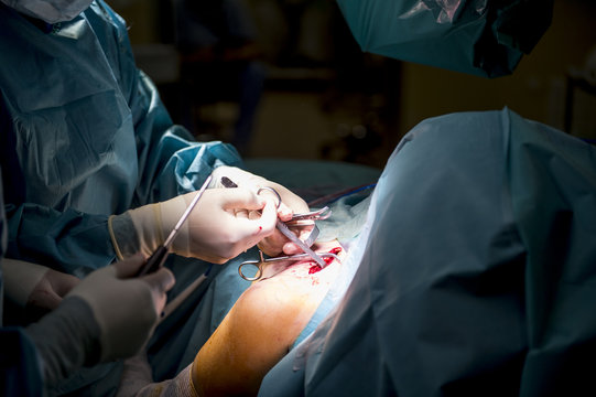 Surgeons doing an achilles tendon surgery in hospital