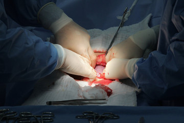 New baby being born during classic cesarean section in the operating theater.