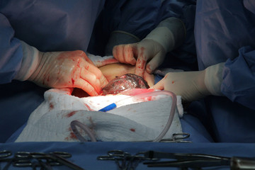 New baby being born during classic cesarean section in the operating theater. - obrazy, fototapety, plakaty