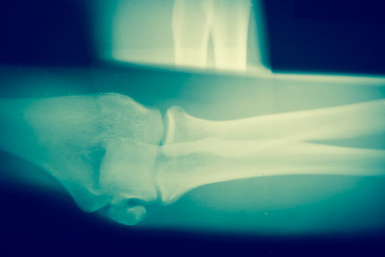 Close up  bone  x-ray