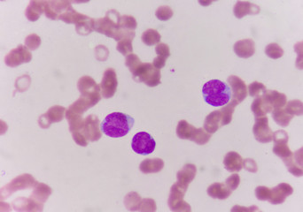 Blast cells in blood smear.