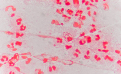 Fototapeta na wymiar Moderate red white blood cells with gram negative diplococci.