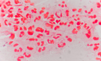 Moderate red white blood cells with gram negative diplococci.