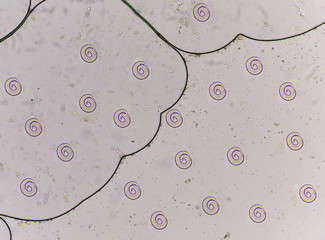  strongyloides in stool exam
