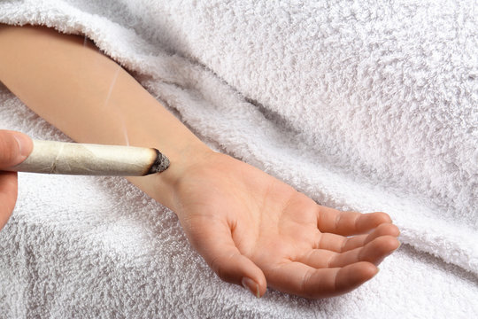 Woman undergoing therapy using moxa stick, closeup