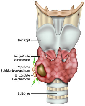 Schilddr&uuml;senkarzinom, Schilddr&uuml;senkrebs, vektor illustration mit Beschreibung auf deutsch